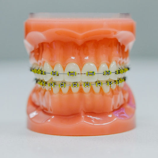 Aparatele dentare fixe