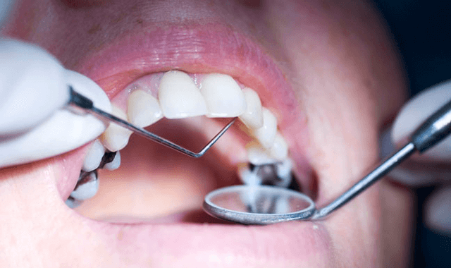 Obturatii dentare fizionomice (Plombe)